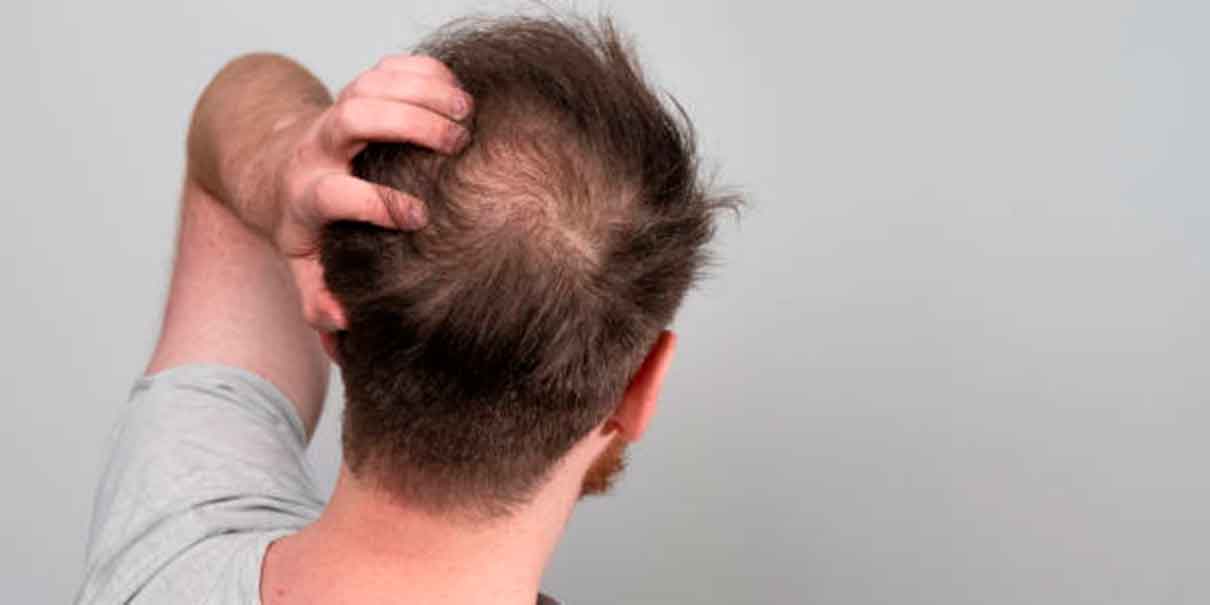 Alopecia en hombres