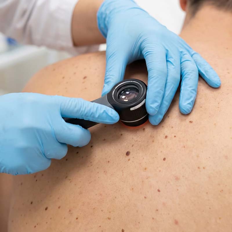 Intismeran autogene es una terapia personalizada contra el melanoma, diseñada para pacientes que ya fueron diagnosticados con cáncer