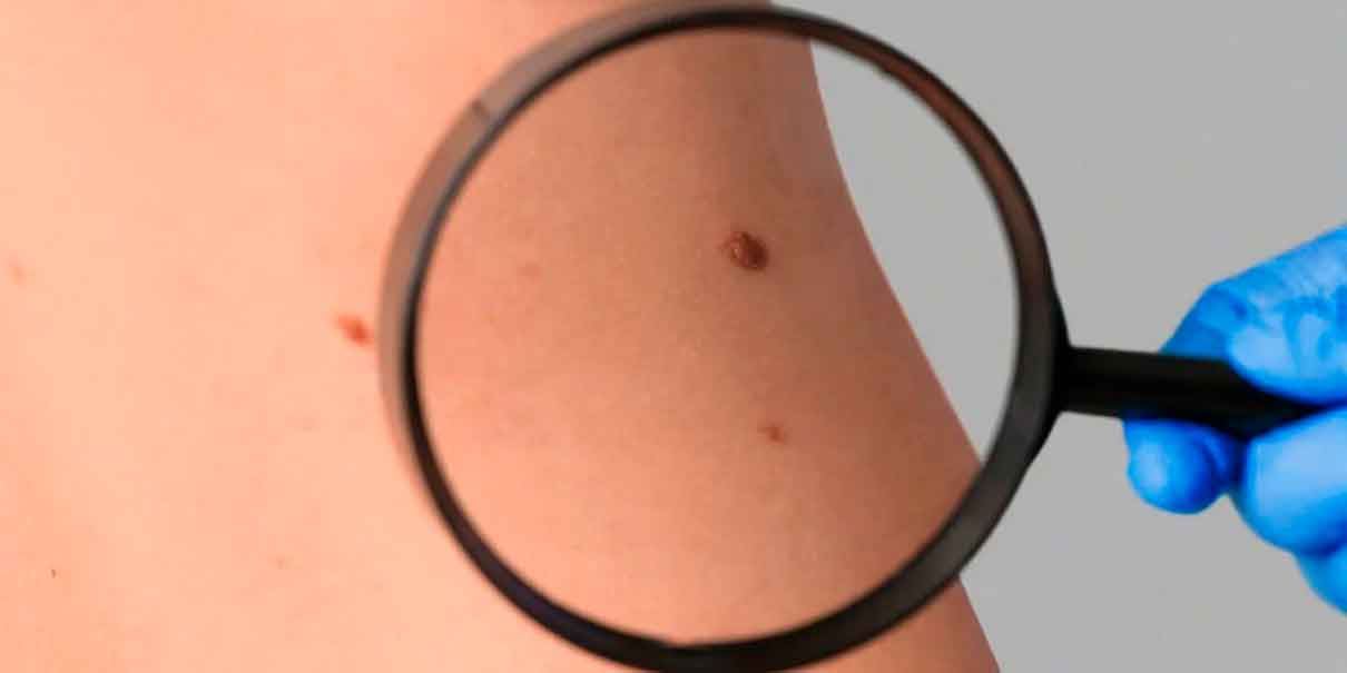 cáncer de piel