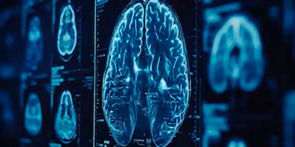 Alzheimer