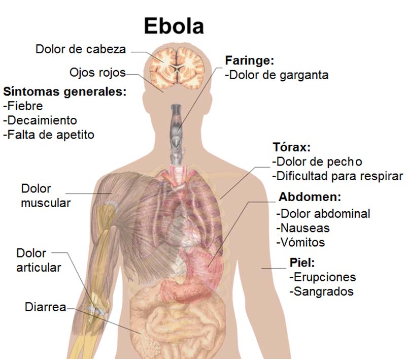 Ébola avanza sin control en Congo: más de 160 muertes y queman centro médico en plena crisis sanitaria