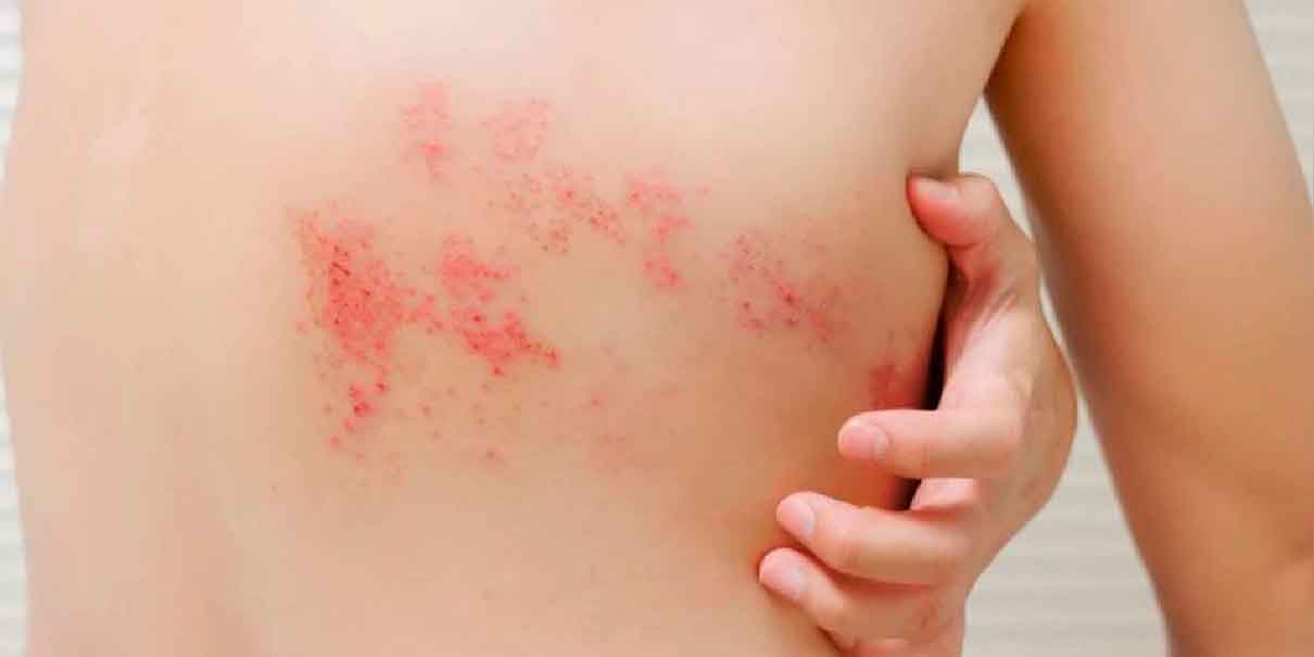 Herpes en la piel