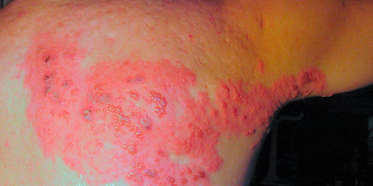 herpes zóster