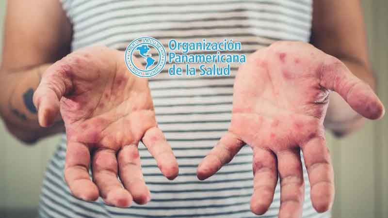 México, primer lugar en casos de sarampión en América, por encima de Canadá y Estados Unidos