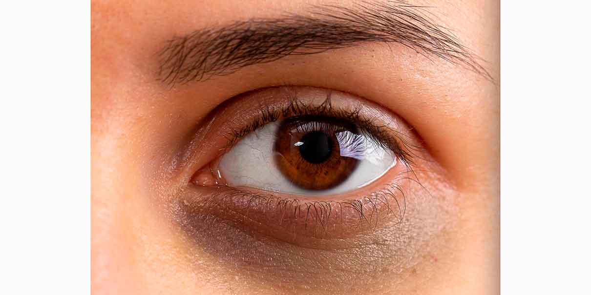 Ojeras