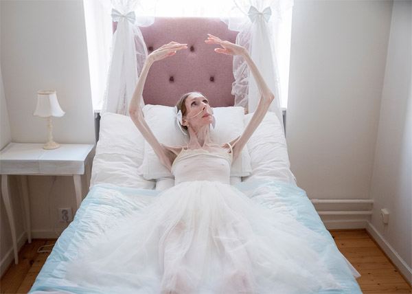 1-	Engla Louise, exbailarina, ha vivido con anorexia nerviosa severa desde que tenía diez años. A sus 46 años, pesa menos de 25 kilogramos y recibe alimentación por sonda desde 2019. Los investigadores describen cada vez más la anorexia como una enfermedad tanto del cuerpo como de la mente.