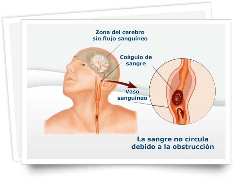 Infarto Cerebral, sólo una atención inmediata te salvará la vida