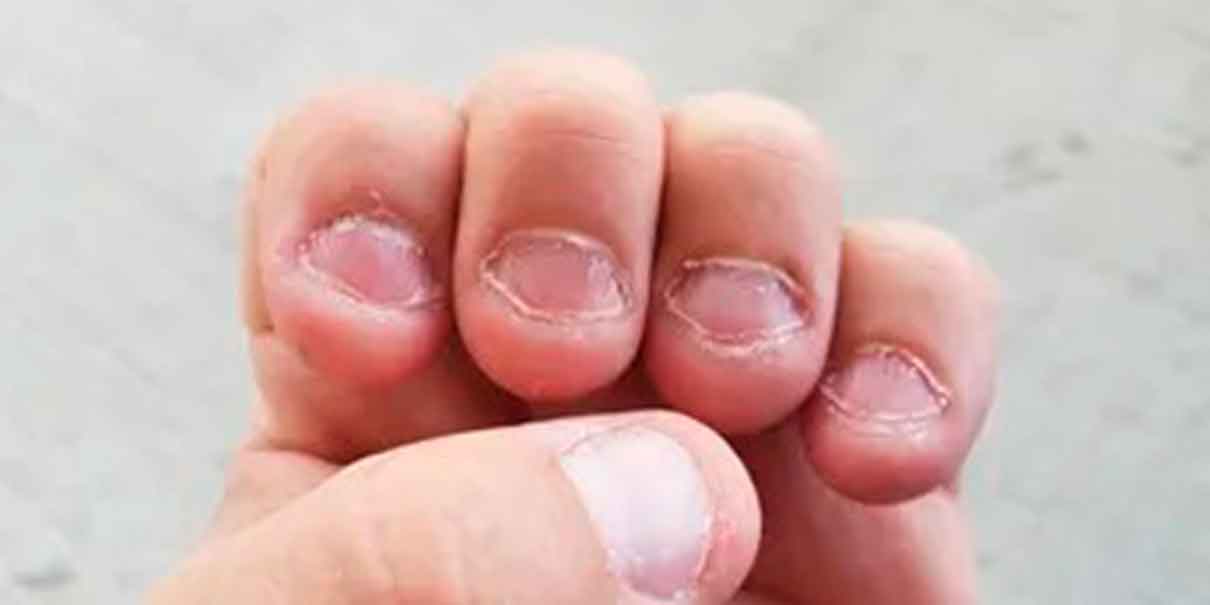 Morderse las uñas