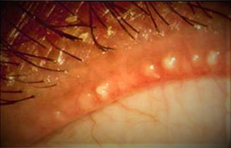 Las glándulas de Meibomio ayudan a mantener los ojos lubricados.