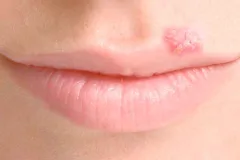 Un virus modificado del herpes podría ser la próxima esperanza contra el cáncer avanzado