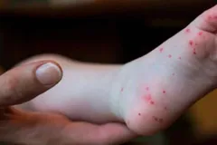 Virus Coxsackie: síntomas, causas, tratamiento y grupos más vulnerables