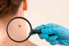 ¿Es un lunar normal? Los cambios en la piel que podrían alertar sobre cáncer
