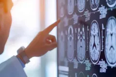 4 hábitos nocturnos que aumentan el riesgo de un derrame cerebral
